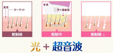 エピレタ　効果　HPL　作用のイメージ